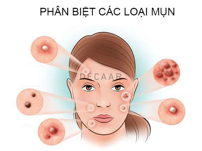 các loại mụn